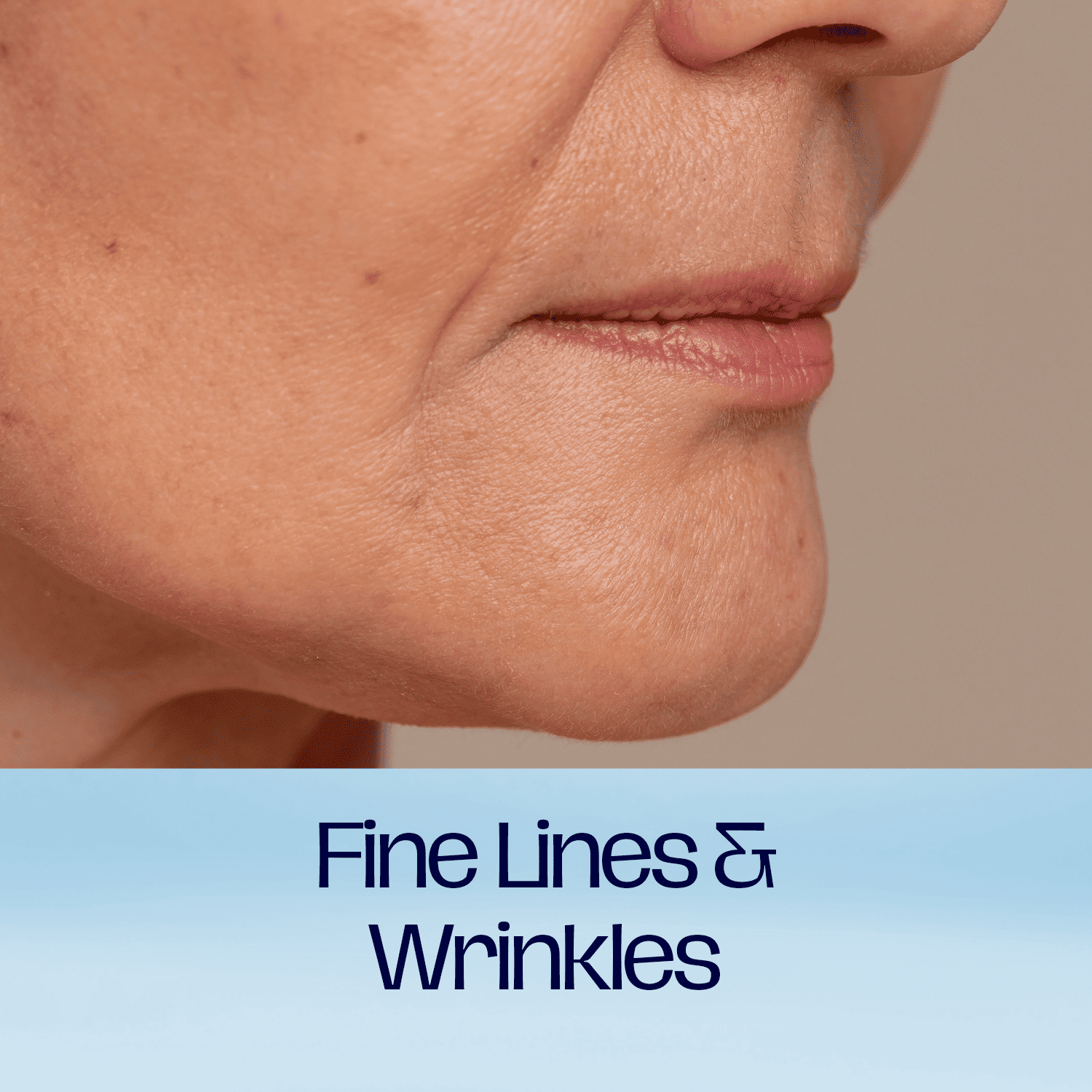 Fine lines and wrinkles
