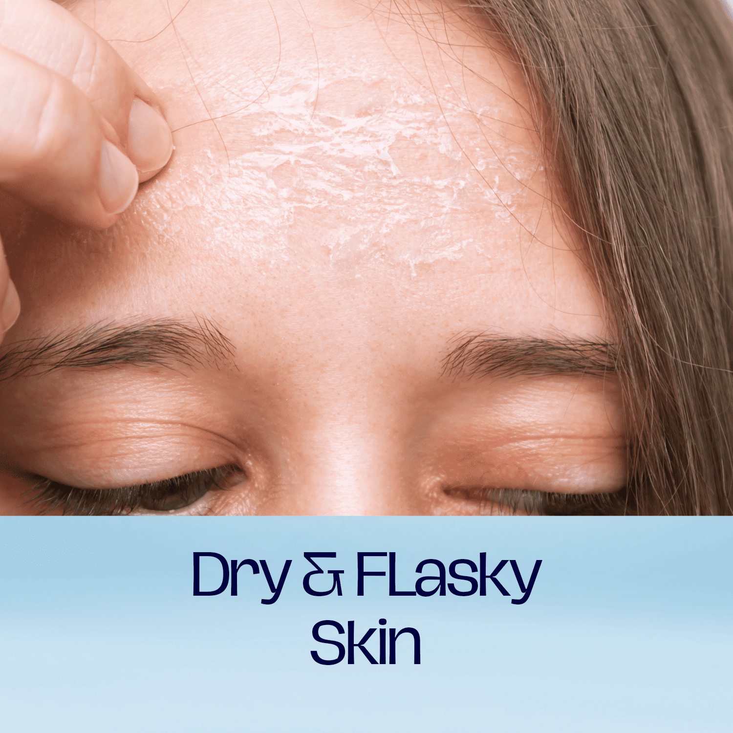 Dry & Flasky Skin